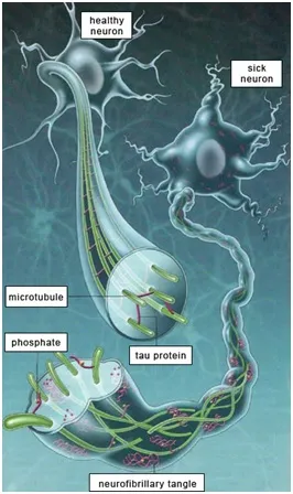 Alzheimer's Disease