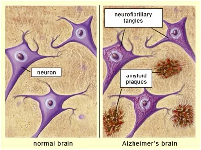 Alzheimer's Disease