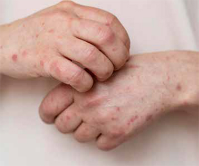 rheumatoid arthritis