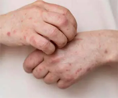 rheumatoid arthritis 