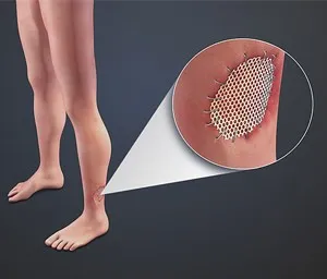 Bone Regeneration